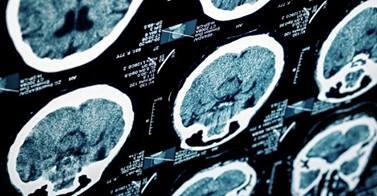 THIS is the single biggest risk factor for #stroke: ow.ly/ty1f4