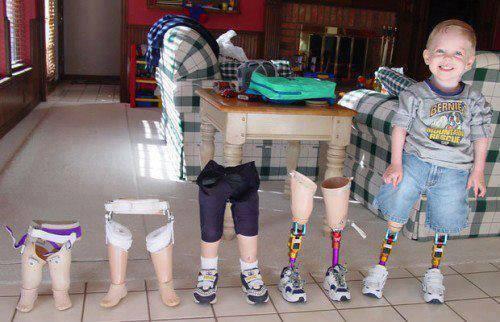 SuchAsomeOne's tweet photo. O büyüdükçe protezleri de büyüyor ve o hala gülümsüyor... http://t.co/jUcb4JUQVY