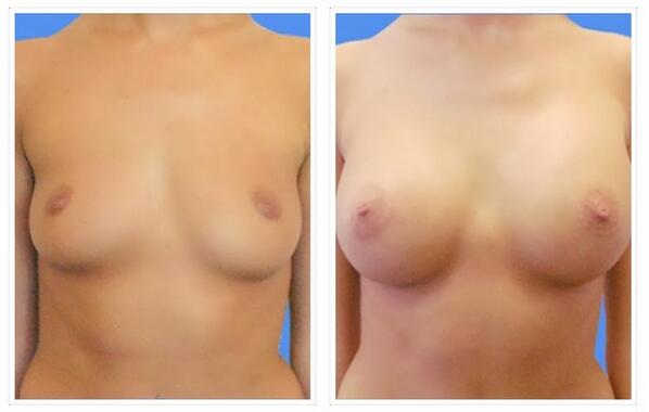 MiamiPSurgeon's tweet photo. Breast Augmentation Gallery http://t.co/hb9mKZh2EP http://t.co/9uv2BlYtZR