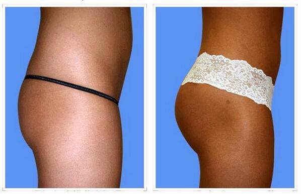 MiamiPSurgeon's tweet photo. Brazilian Butt Lift Gallery http://t.co/tzGTju6fHW http://t.co/TgmyXcI2Uq