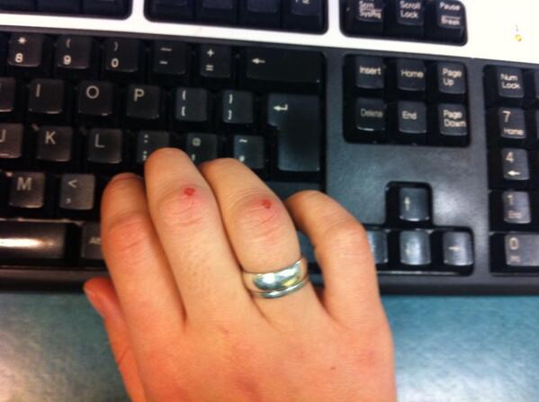 RT <a href="/jennycork/">Jenny Cork</a>: Worth a Front Page? Knuckle injury from scrubbing kitchen tiles. <a href="/BBCSheffield/">BBC Sheffield</a> @TobyFoster