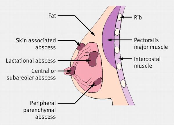 The BMJ on X: Diagram showing common sites and types of breast