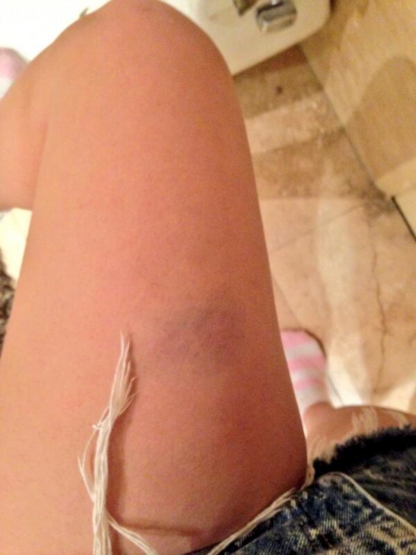MaytalLove's tweet image. Welcome to the collection. #bruised #dontknowhow