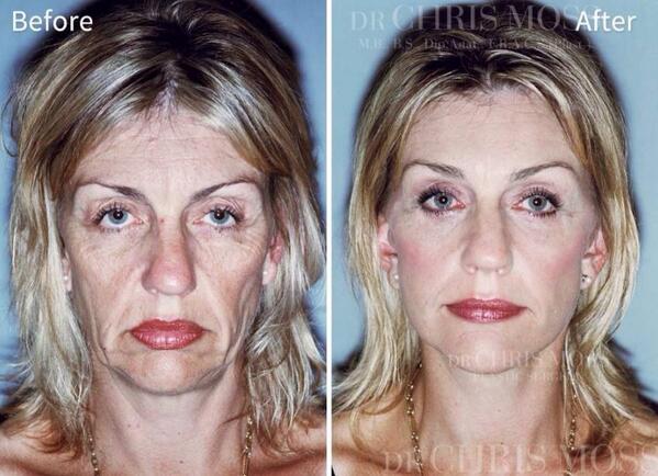 Dr Chris Moss Here I Performed My High Smas Facelift Which Includes Mid Check Lower Face And Lateral Neck Correction Plus Lids Http T Co V8nrw4yh4m