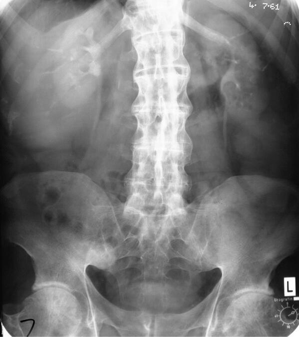 Ankylosing Spondylitis Bamboo Spine