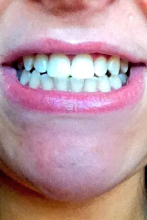 _Cbeauty's tweet photo. Teethe whitening after 20 mins of whitening :) x http://t.co/wh0IG7JLqw