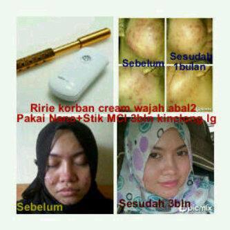Technology Japan,apapun mslh kulitmu solusinya Nano spray+Magic Stick.Buktiin sendiri,bukan janji.Pin 24db8320