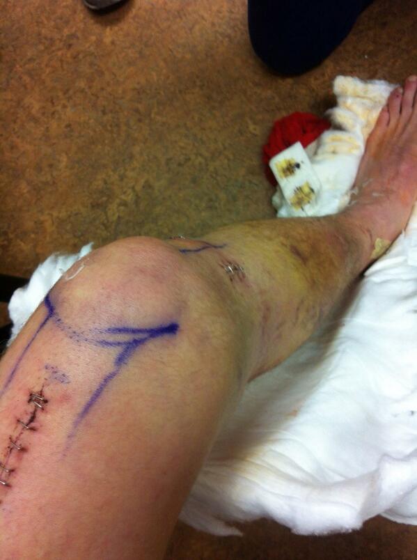 NSchaper_PBR's tweet photo. Got my split off and staples out last week, doctors say I'm healing up nicely. http://t.co/xuHiDh505l