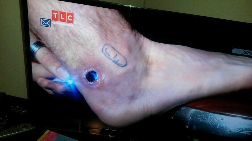 Achilles piercing online