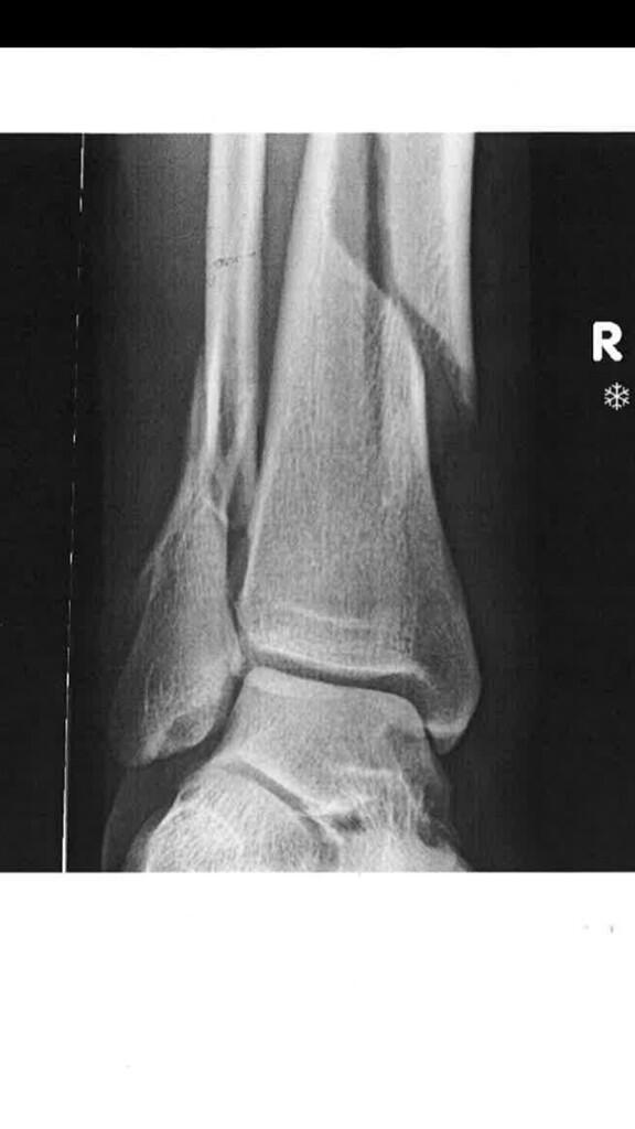 tom92bond's tweet image. Thanks for all the concerned tweets ladies and gents, luckily it's just a light sprain #fibandtib #doublebreak