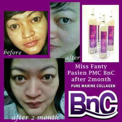 PMC mengandung bibit kolagen grade AAA.Kulit putih&amp;sehat,tubuh terbebas dr berbagai macam penyakit.Pin 26a27818