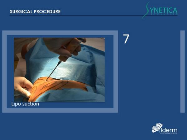 IDERMMEDICAL's tweet image. SYNETICA EVO surgical procedure SMART LIPO
7. Fats suction