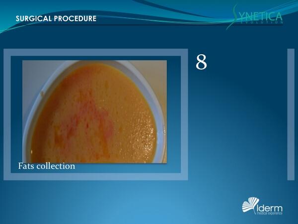 IDERMMEDICAL's tweet image. SYNETICA EVO surgical procedure SMART LIPO
8. Fats collection