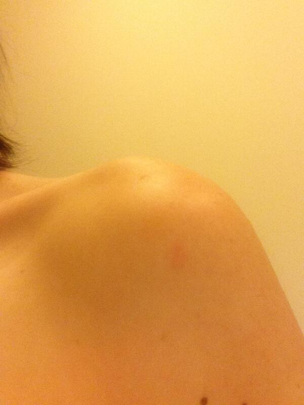 AmyJaneGilbert's tweet image. #Monkeybite