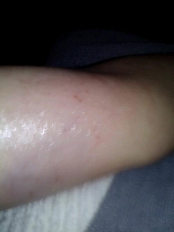 hunterromaine's tweet photo. I just broke a arm http://t.co/7pmaC8BCiZ