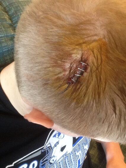 NGoeden's tweet photo. You know it was a good weekend/night wen u wake up with a whole in ur head with staples! #oww?? http://t.co/sZOF6SIq2h