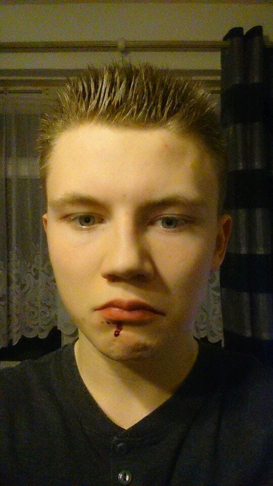 JamesNXTzz's tweet photo. Shaving injuries http://t.co/9Eu93pBZmi
