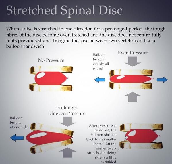 JanAlvarezVives's tweet image. Spinal disc #physiotherapy #spinaldisc