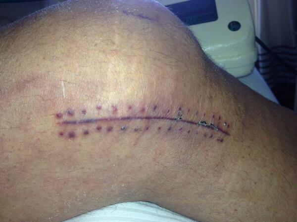 Kyle_Hendo's tweet photo. Couple staples in the knee #nbd http://t.co/Lf6eRZgV6M