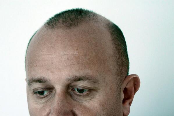 docibrahimaskar's tweet photo. Saçlarımız Neden Dökülür? - http://t.co/gxl7TqCTFB http://t.co/pwNRtWgoLh
