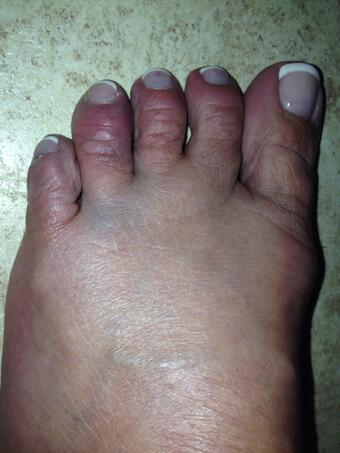Broken toe :-( http://t.co/HVVLQGbxpk<a href="/tag/bethethunder"class="tags"><span>#bethethunder</span></a><a href="/tag/gobolts"class="tags"><span>#gobolts</span></a><a href="/tag/golightning"class="tags"><span>#golightning</span></a>