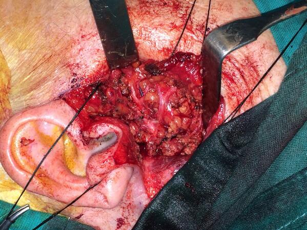 melissamalvis's tweet photo. Ramas del Nervio Facial después de una Parotidectomía! http://t.co/m8eAiO2sQA