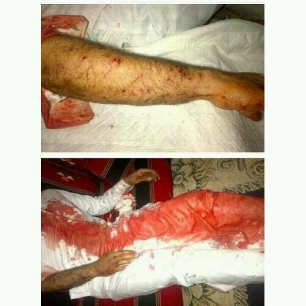 SAIDYOUSIF's tweet photo. Shotgun injury by riot police in sitra this evening #bahrain http://t.co/42bKWmb73w