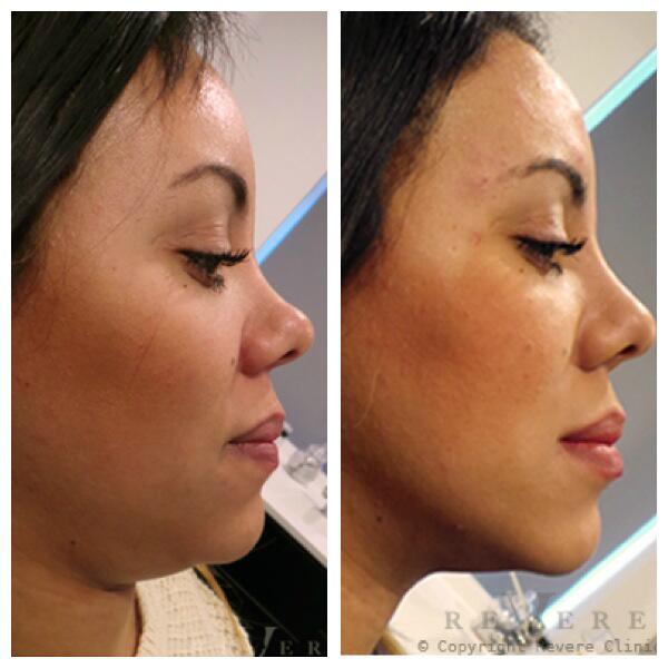 Акваликс липолитик до и после. Профиль джоли углы челюсти. Углы джоли в профиль. Новый подбородок. Новый подбородок.