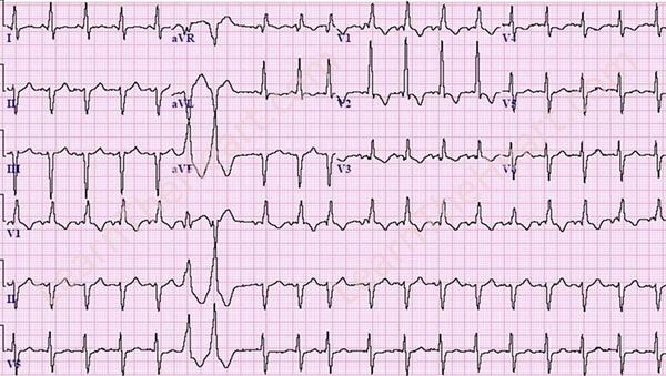 Learntheheart Com This Ecg Shows Sinus Tachycardia Rbbb Lafb Pvc Ventricular Couplet Pac Lvh From Ecg Quiz Http T Co Zj8uouohu6 Http T Co Gkqmj5dbtb