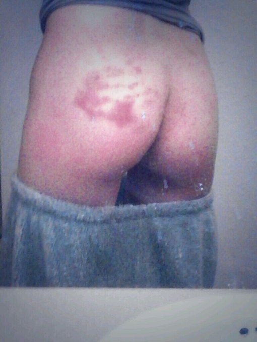 My roommate bruised me lol http://t.co/uSTWvchiR2<a href="/tag/teamrider"class="tags"><span>#teamrider</span></a>