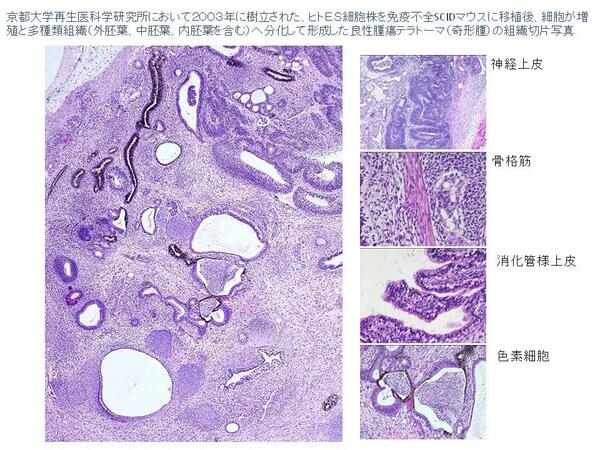 Norio Nakatsuji Ar Twitter テラトーマ とはどんなの 最近関心疑問受取るので情報提供 京大再生医科学研究所で樹立したヒトes細胞株が作ったテラトーマの写真 Es Ips細胞の多能性検定に使われるが定量性不足や動物実験と数ヶ月必要なので代替方法を国際共同研究で Norio Nakatsuji Ar Twitter テラトーマ とはどんなの 最近関心疑問受取るので情報提供 京大再生医科学研究所で樹立したヒトes細胞株が作ったテラトーマの写真 Es Ips細胞の多能性検定に使われるが定量性不足や動物実験と数ヶ月必要なので代替方法を国際共同研究で