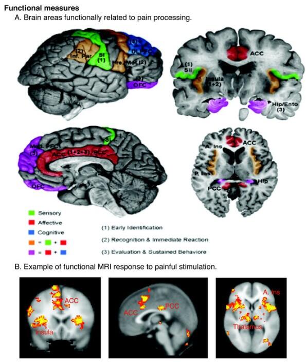 LeandroGutman's tweet photo. Áreas cerebrales relacionadas con el procesamiento del dolor. AREAS, EN PLURAL!!!!!!!!! http://t.co/lnkXYpFdfx