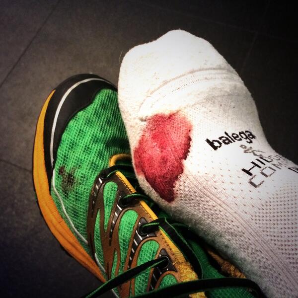 jgbcoaching's tweet photo. Worse than I though. #running #blisterthatwontheal http://t.co/0GnfRkIuvz