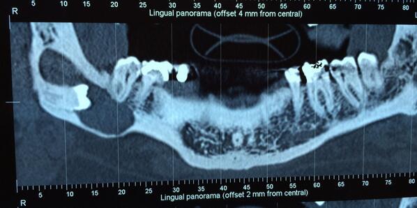 melissamalvis's tweet photo. Quiste folicular, cerca de la Basal del Hueso, con posible fractura!! http://t.co/alUEIU3SjN