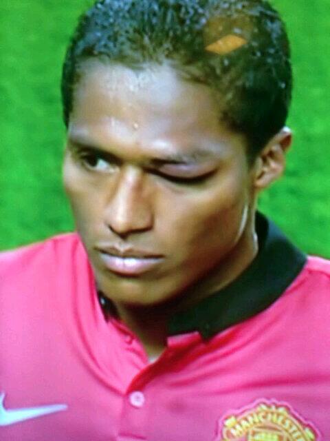 UtdIndonesiaSBY's tweet photo. Selain hanya mengandalkan kaki kanan saja, di sisa match ini Valencia jg harus mengandalkan mata kanannya saja :( http://t.co/R2VNReco4m