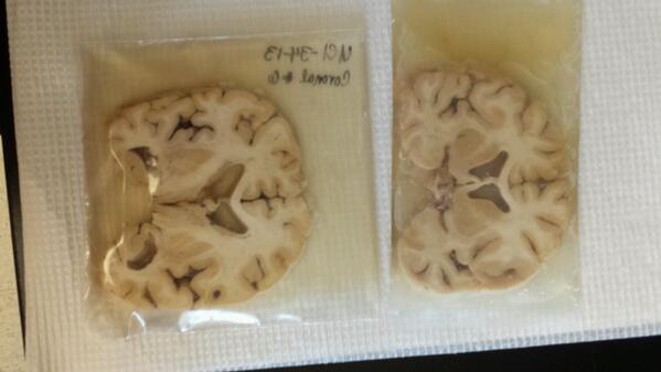 WeAreHFC's tweet image. Wanna see something gross/fascinating??  A cross section of an alz brain (left) vs healthy brain (right)