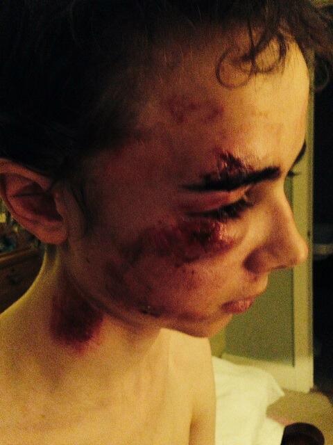 BBCWiltshire's tweet image. NEWS: Ollie Pike, from near #Malmesbury had been cycling in Gloucestershire when a pothole threw him from his bike.