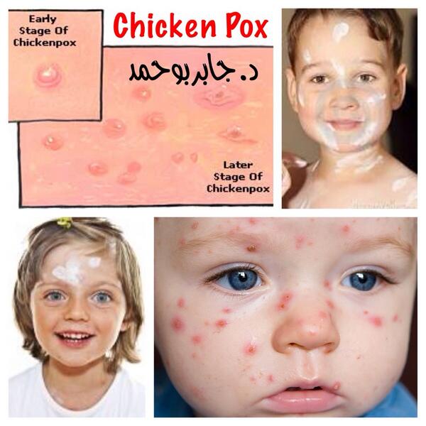 Arabic Lesson Podcast Chicken Pox