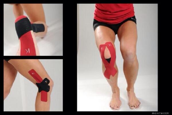 тейпирование мениска коленного сустава. тейпинг коленного сустава. тейпирование коленного сустава надколенника. тейпирование коленного сустава кинезио. тейпирование мениска коленного сустава.