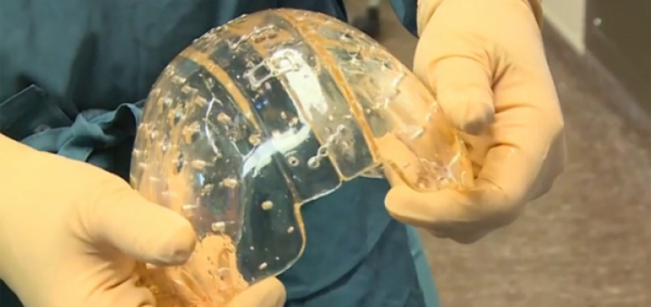 MaRSDD's tweet image. RT @My3DPrinting: 22 Year Old Receives Complete 3D Printed Cranium Replacement - 3dprint.com/1795/22-year-o…  #lifesciences