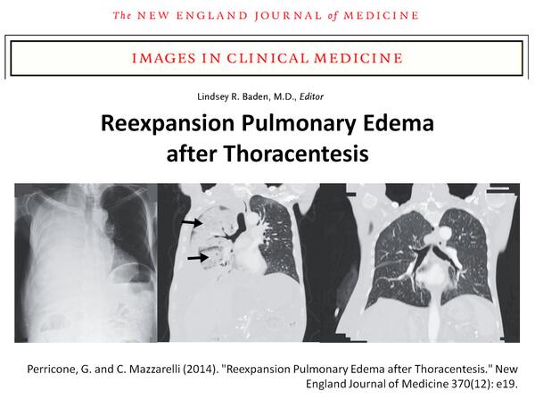 VicenteLozadaB's tweet image. #Reexpansion Pulmonary Edema after #Thoracentesis (#NEJM, 2014) nejm.org/doi/full/10.10…  @cateterdoblej