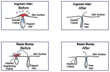 Pfb Vanish Usa On Twitter What Is Pfb Psuedo Folliculitis