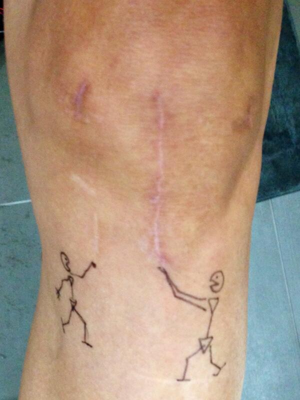 ACL_not_again's tweet photo. Giving the term "battle scars" a new meaning...#ACLasagne #ACLx2 #ACL5 http://t.co/Y7hvDLOP5G