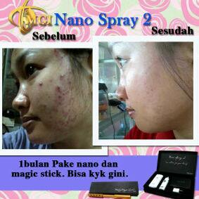 Nanospray&amp;MS. #Jerawat #Komedo #Flek hilang tanpa hrs bolak-balik salon Hub: <a href="/body_slimming/">chow2_shop</a> pin:24db8320
