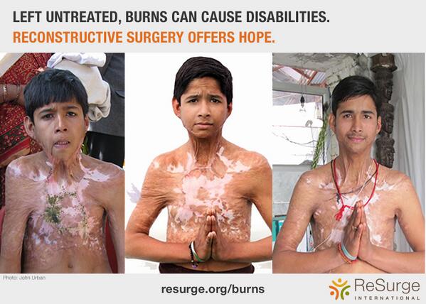 Burn Awareness tweet media