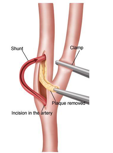 UCLAHealth's tweet image. Carotid endarterectomy is used to remove plaque &amp;amp; clots in the neck #UCLAMDChat