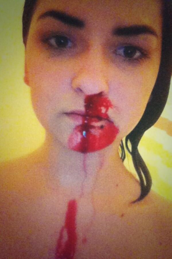 gee_bvb's tweet image. Had 6 nose bleeds in 24 hours dont know what happened it came out of both nostrills and my mouth!!!!