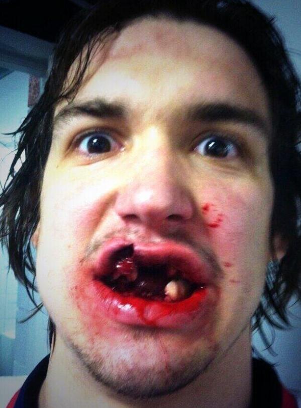 WTPHockeyFacts's tweet photo. This was Mitch Callahan of the Grand Rapids Griffins selfie after being hit in the face by a slapshot: http://t.co/Y9bYIxZY71