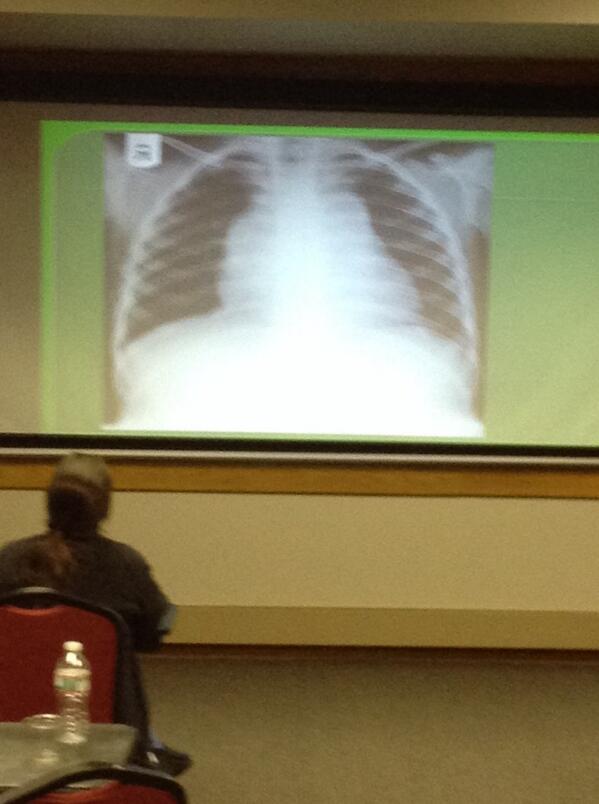 JoeLex5's tweet image. #emconf @TempleEM #casecon New DDx.  Leukemia.  Also: TTP / HUS / DIC.  Fever / sepsis.