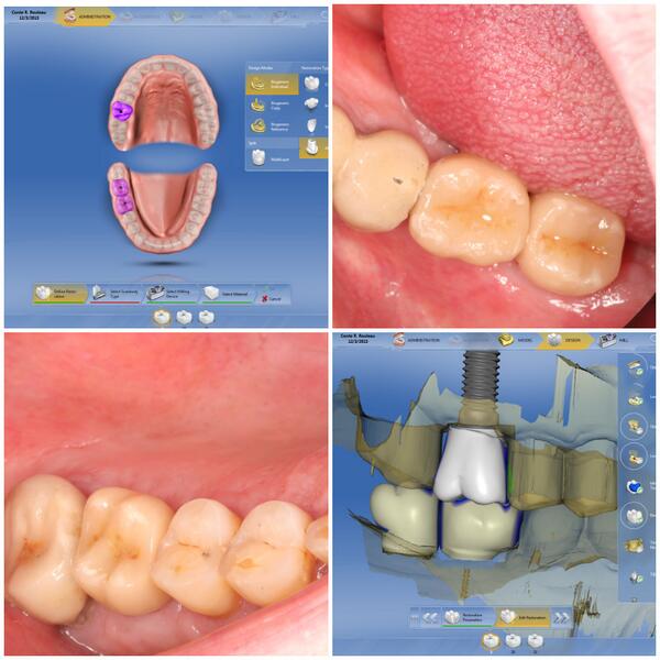 DSCEREC's tweet photo. >>http://t.co/Yf7GdAq8cl #CEREC multiple custom abutments case using @Vident Vita #Enamic blocks. http://t.co/fSmkXIRnGD
